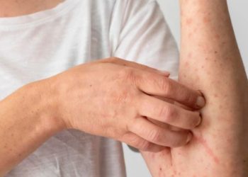 Penyakit Sifilis: Gejala, Penyebab, dan Pengobatannya