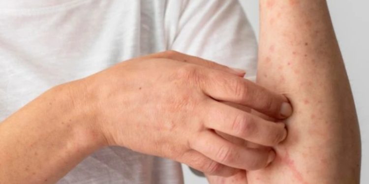 Penyakit Sifilis: Gejala, Penyebab, dan Pengobatannya