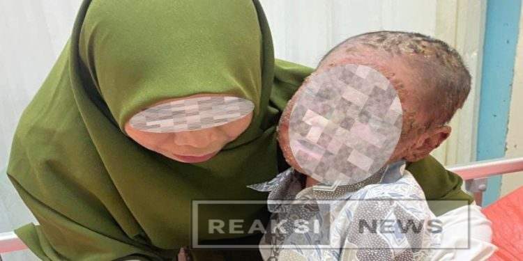 Bocah 7 Tahun di Sukabumi, Pengidap Penyakit Langka Candidiasis, Tidak Ada Bantuan Pemerintah, cek faktanya