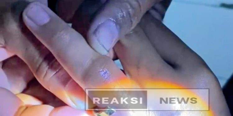 Damkar Posko VII Sukaraja Berhasil Lepaskan Cincin yang Terjepit di Jari Anak SMP